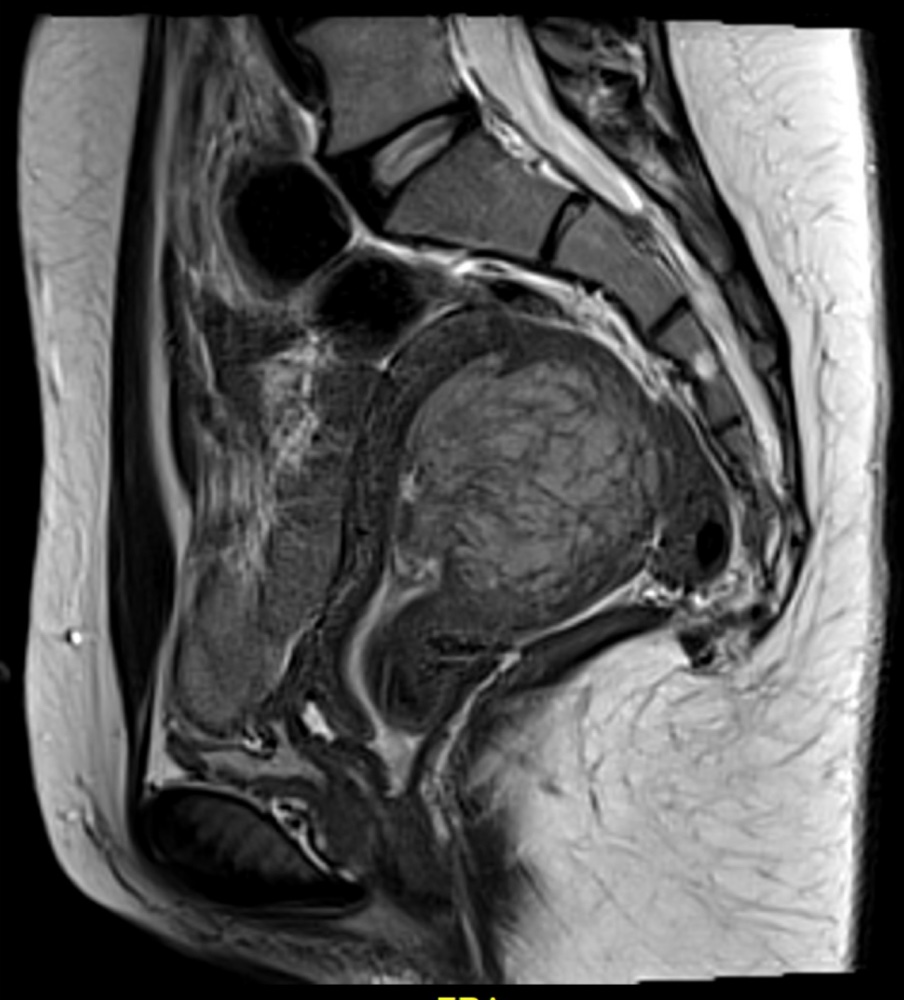 子宮内膜間質肉腫 MRI T2強調像 矢状断像