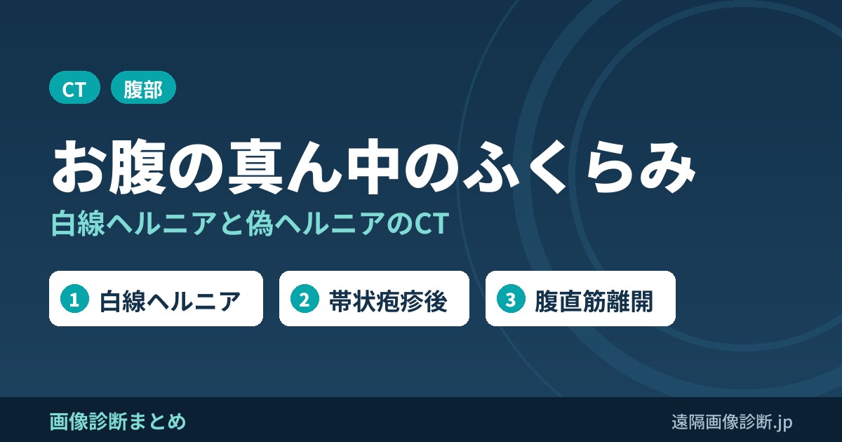 お腹の真ん中のふくらみ 白線ヘルニアと偽ヘルニアのCT