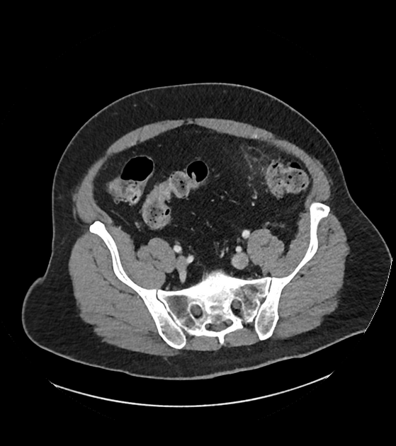 腹膜垂炎 CT