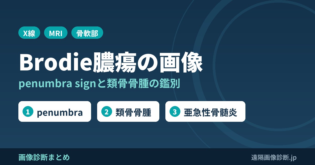 Brodie膿瘍のレントゲン・MRI画像所見｜penumbra signと類骨骨腫との鑑別