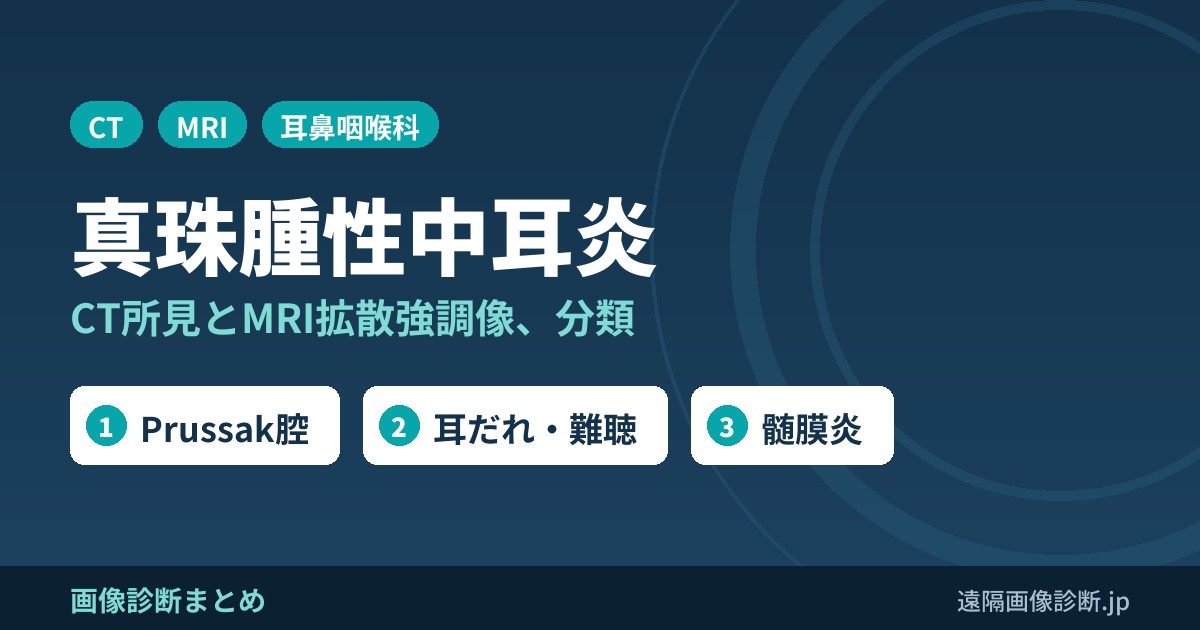 真珠腫性中耳炎とは？CT画像所見(Prussak腔・scutumの破壊)とMRI拡散強調像、分類