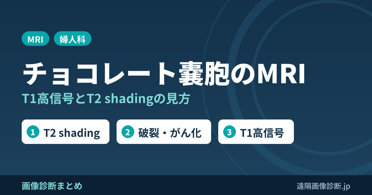 チョコレート嚢胞(卵巣内膜症性嚢胞)とは？原因・症状とMRI画像所見(T1高信号・T2 shading)、破裂・がん化の注意点