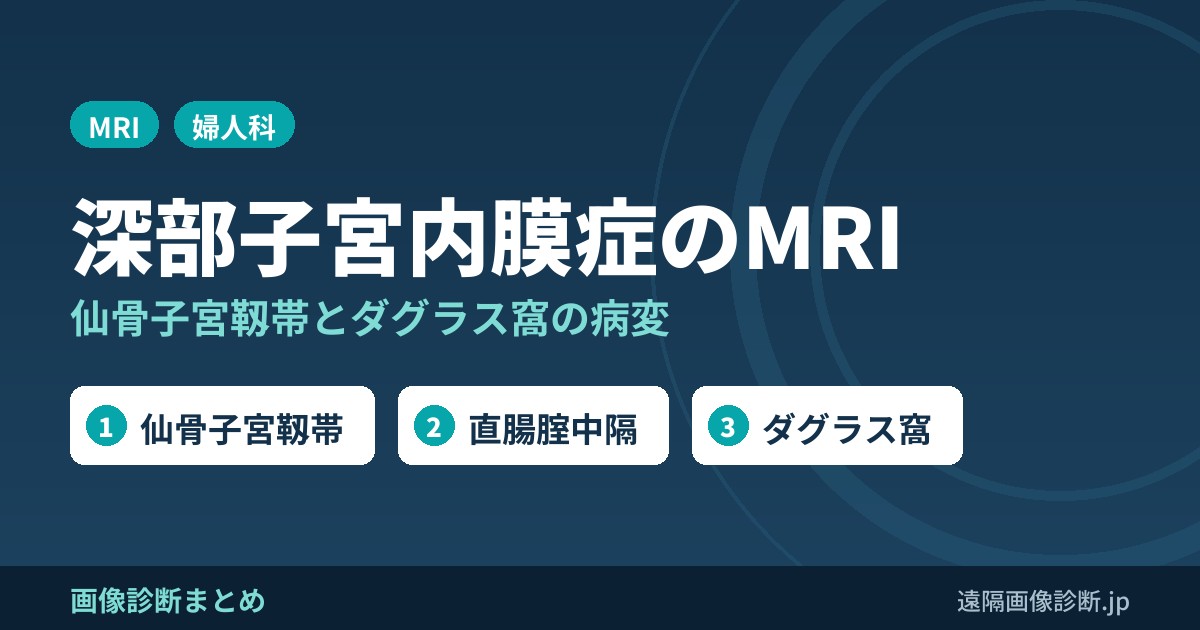 深部子宮内膜症のMRI画像診断｜仙骨子宮靱帯・直腸腟中隔の病変とダグラス窩閉鎖