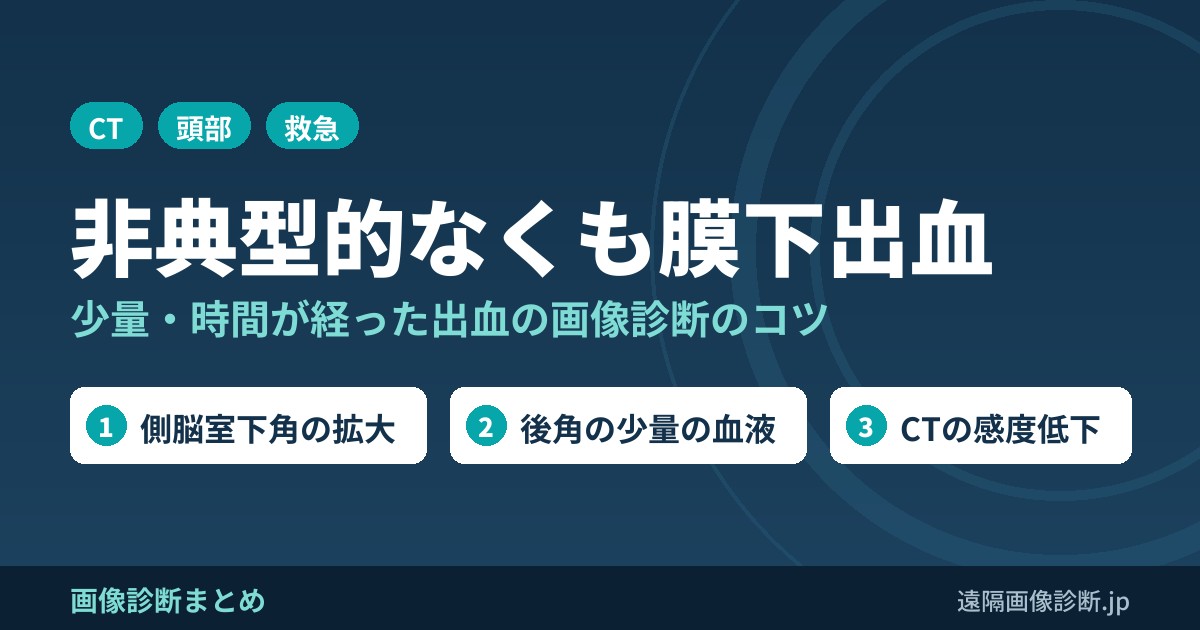 非典型的なクモ膜下出血(SAH)の画像診断