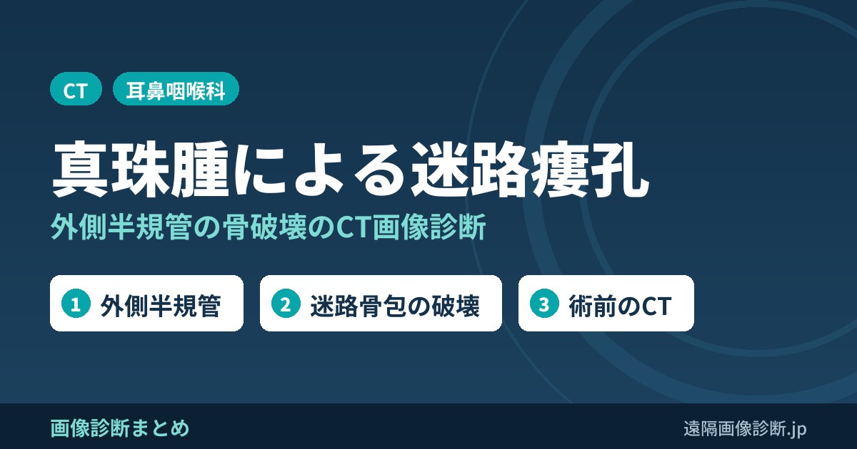 真珠腫による迷路瘻孔、半規管瘻孔のCT画像診断