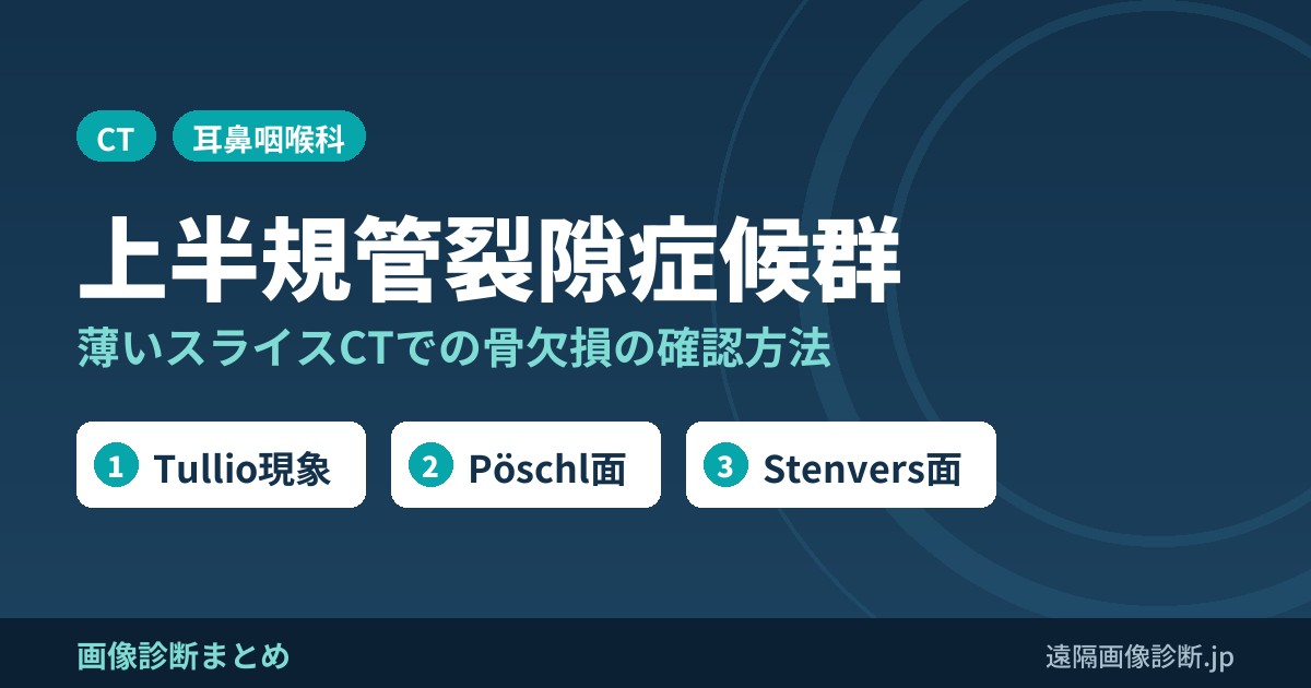 上半規管裂隙症候群の画像診断(superior canal dehiscence syndrome)