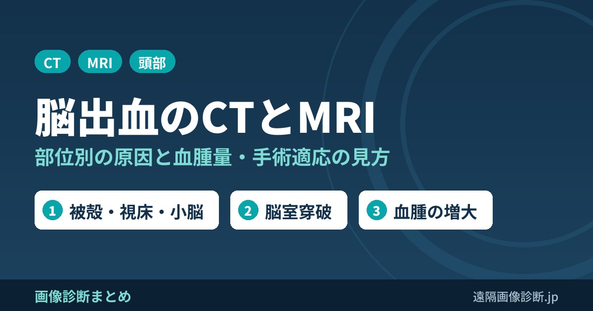 脳出血のCT,MRI画像診断まとめ(高血圧性、被殻、視床、小脳、橋)