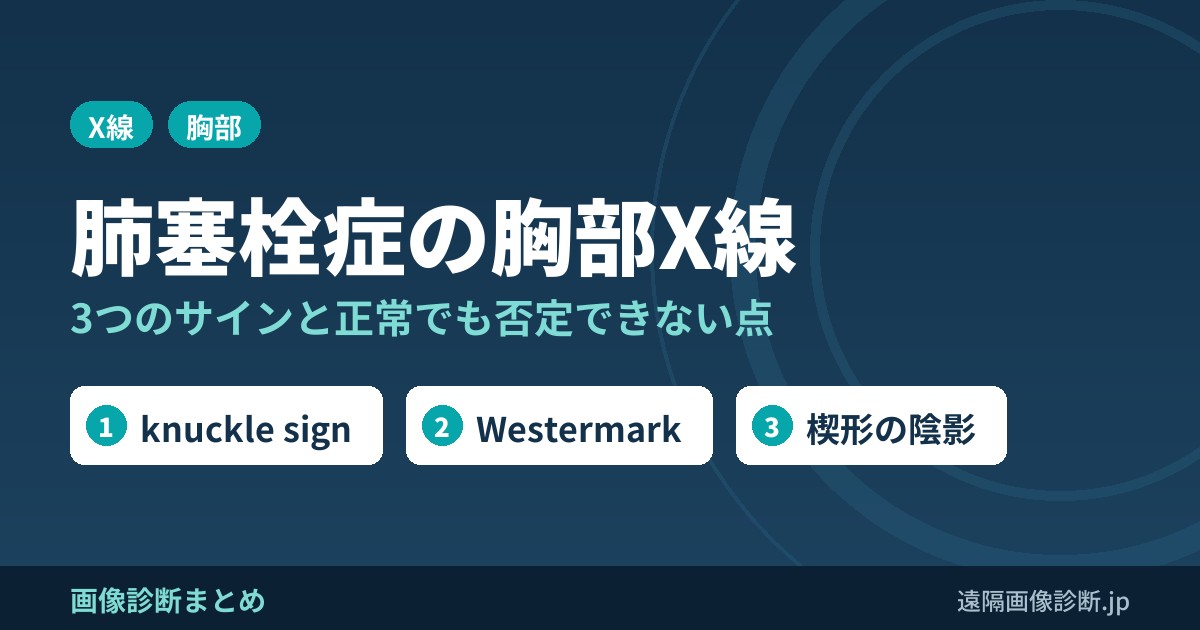 肺塞栓症の胸部X線所見｜knuckle sign・Westermark sign・Hampton's hump