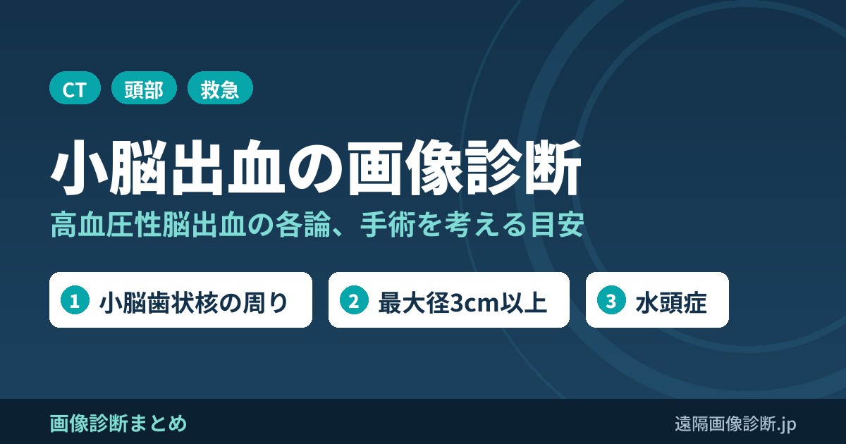 小脳出血の画像診断(高血圧性脳出血各論)