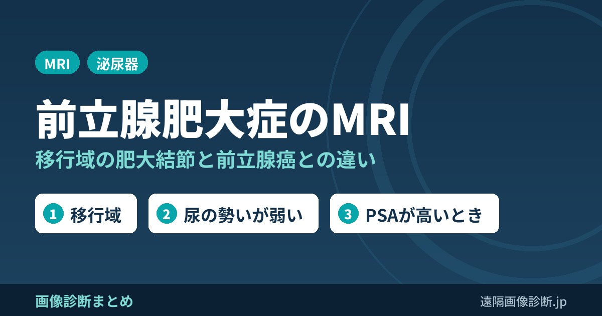 前立腺肥大症のMRI画像診断｜移行域の肥大結節と前立腺癌との違い