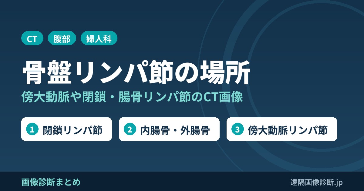 骨盤リンパ節・傍大動脈リンパ節の場所と名前｜閉鎖・内腸骨・外腸骨リンパ節のCT画像