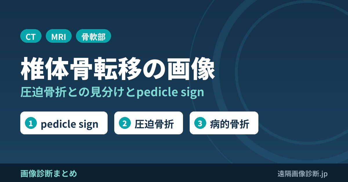 椎体骨転移のCT・MRI画像診断｜骨粗鬆症による圧迫骨折との見分け方(pedicle sign)