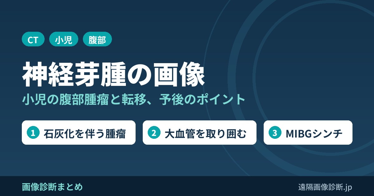 神経芽腫の症状、画像診断、転移、予後
