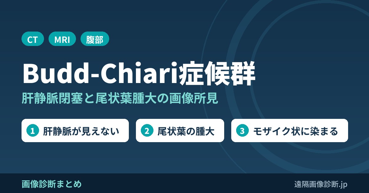 Budd-Chiari症候群のCT・MRI画像所見｜肝静脈閉塞と尾状葉腫大