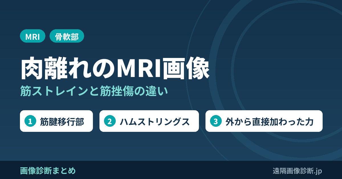 肉離れ(筋ストレイン)・筋挫傷のMRI画像診断｜違いと重症度分類、CTでわかる？