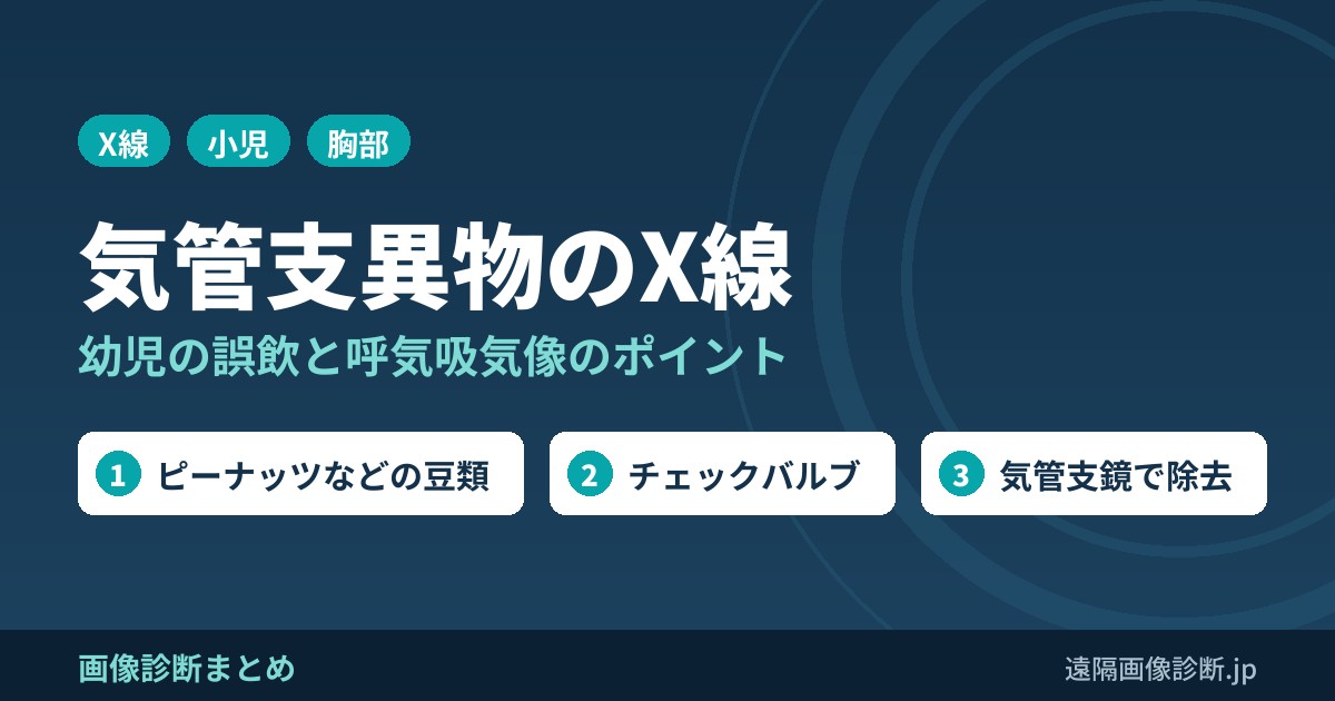 気管支異物とは？症状、原因、レントゲン画像(異物誤飲)まとめ！