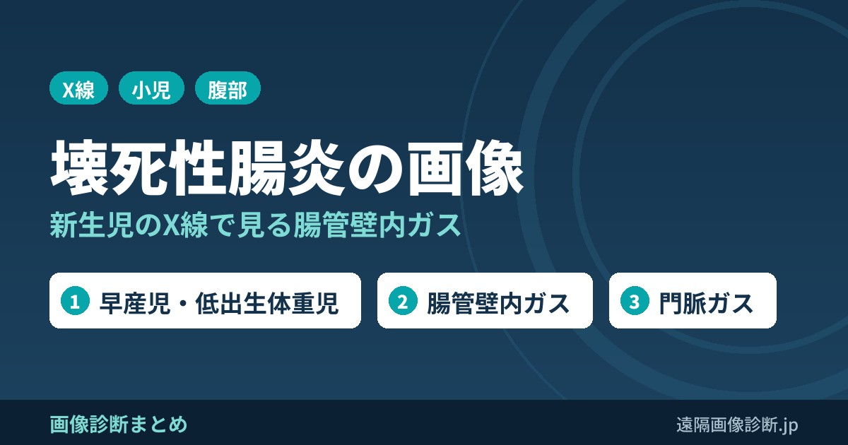 壊死性腸炎の症状、危険因子、画像診断