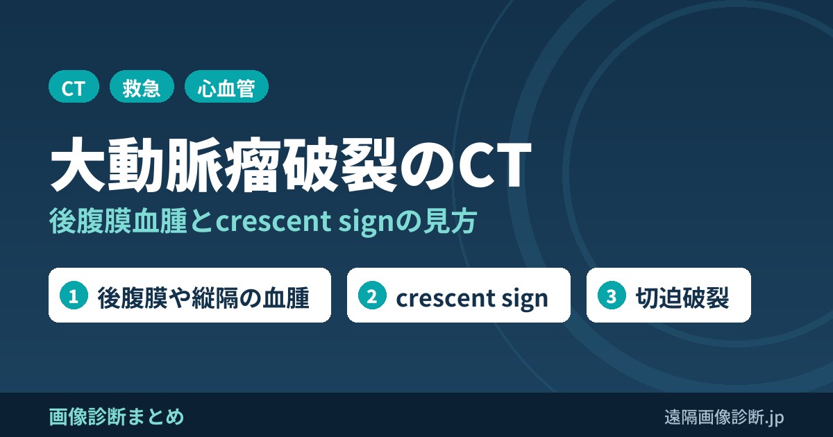 大動脈瘤破裂のCT画像所見｜後腹膜血腫・crescent sign(切迫破裂)と治療適応