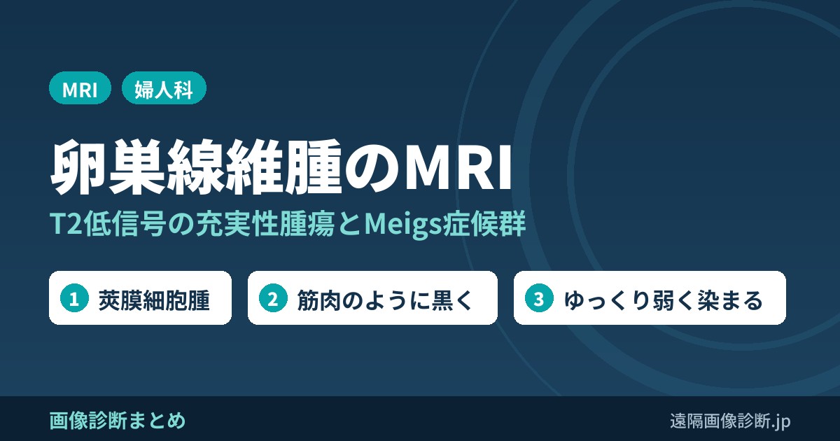 卵巣線維腫・莢膜細胞腫のMRI画像診断｜T2低信号の充実性腫瘍とMeigs症候群