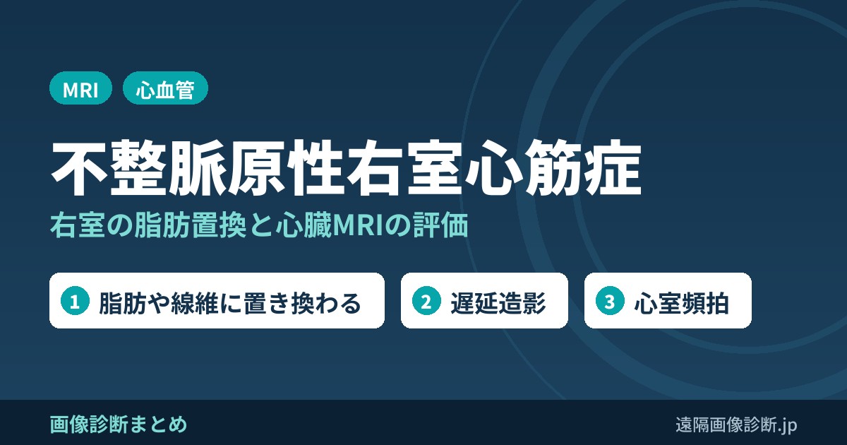 不整脈源性右室心筋症の画像診断