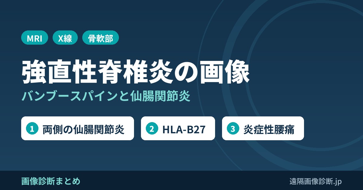 強直性脊椎炎の画像診断｜バンブースパイン(bamboo spine)・仙腸関節炎のMRI・レントゲン・CT所見
