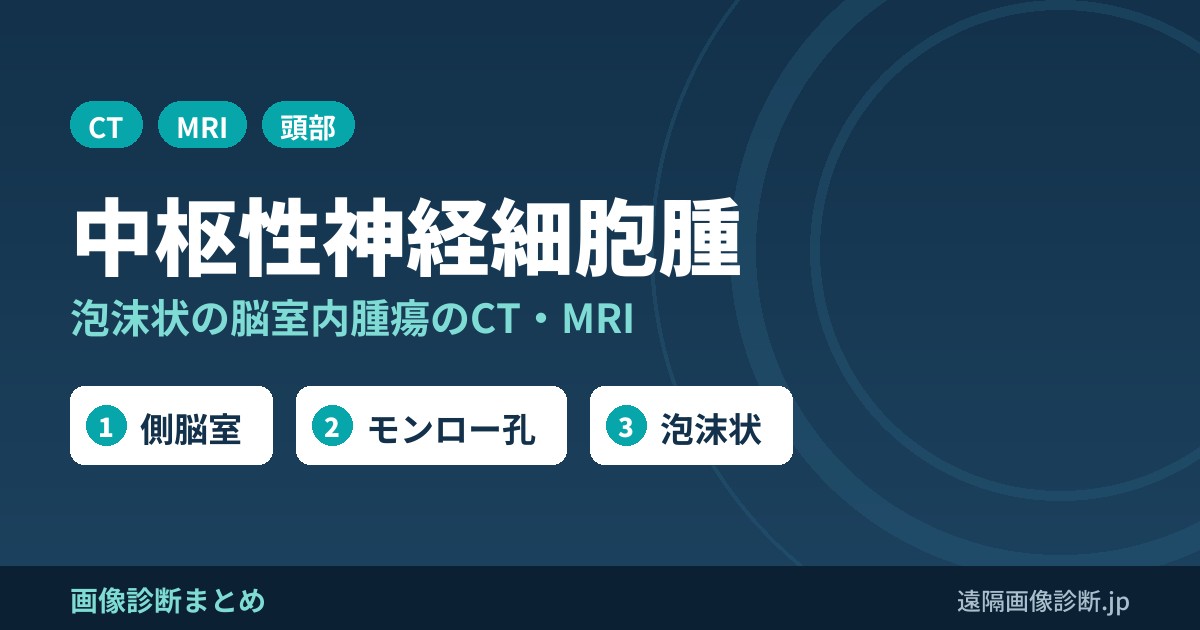 中枢性神経細胞腫(central neurocytoma)のCT・MRI画像所見｜泡沫状の脳室内腫瘍