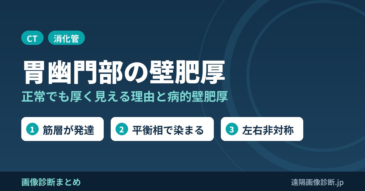 胃幽門部は筋層が発達して壁肥厚に見える｜CTでの正常と病的壁肥厚の見分け方