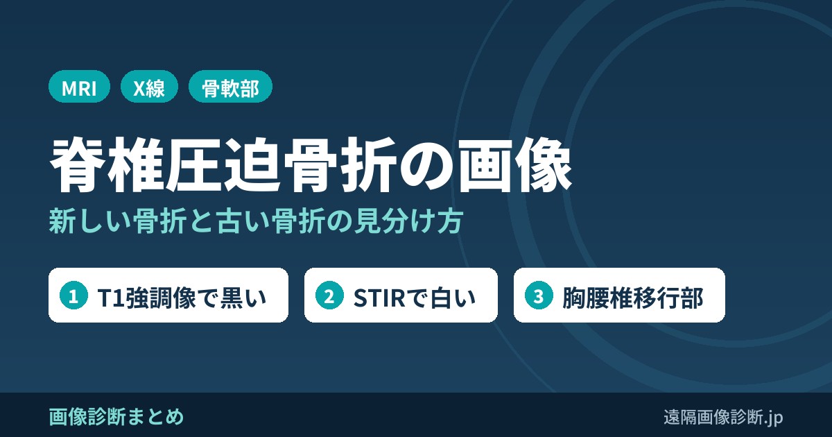 脊椎圧迫骨折の画像診断｜新しい骨折と古い骨折の見分け方(MRI・STIR)と原因
