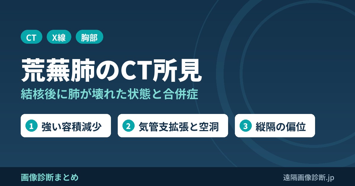 荒蕪肺(destroyed lung)とは？CT・レントゲン所見と合併症