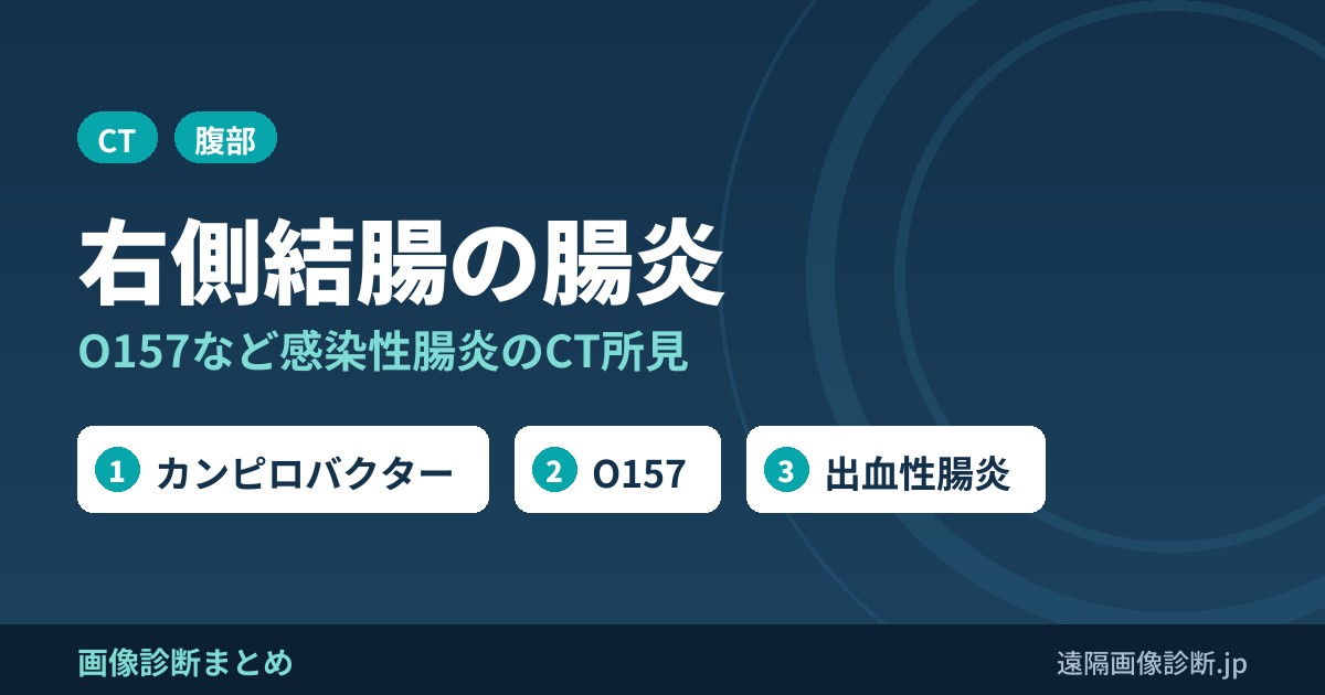 右側結腸の腸炎の鑑別診断｜感染性腸炎(O157・カンピロバクターなど)のCT所見