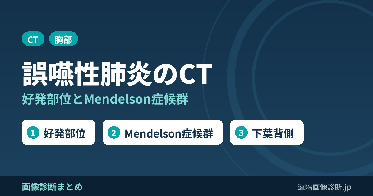 誤嚥性肺炎のCT画像所見｜好発部位(下葉背側・右側)とMendelson症候群