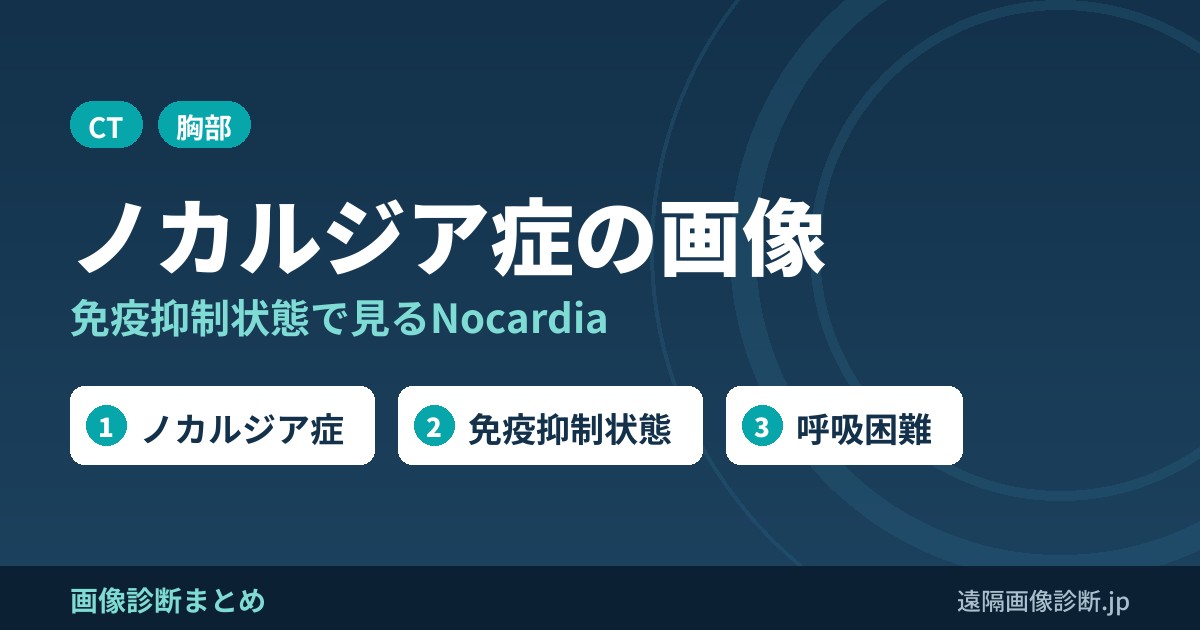 ノカルジア症の画像診断(Nocardia)
