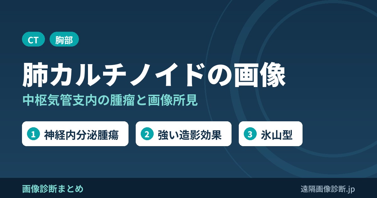 肺カルチノイド(carcinoid)とは？画像診断のポイントは？