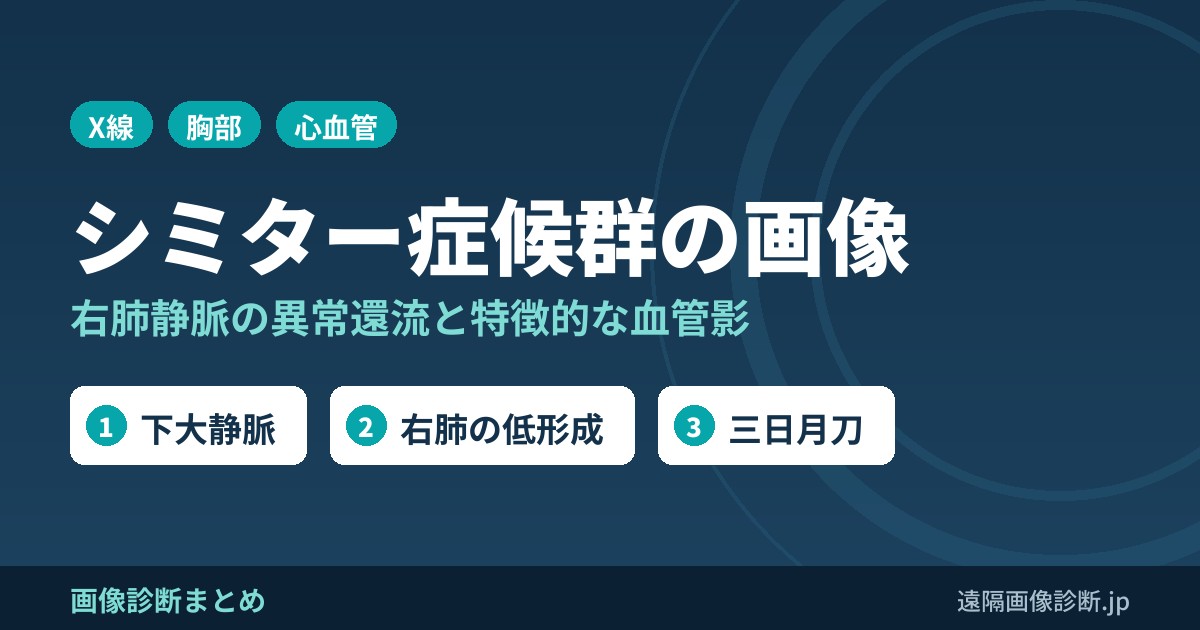 Scimitar syndrome(シミター症候群)の画像診断