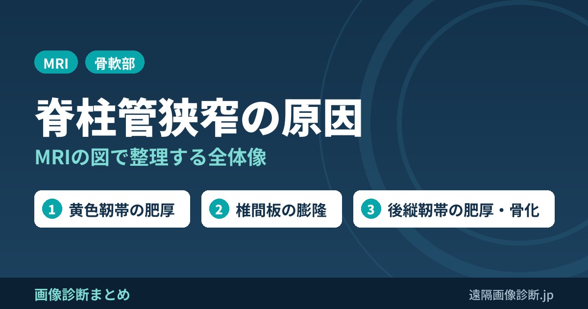 脊柱管狭窄の原因まとめ！MRIの図でわかりやすく！