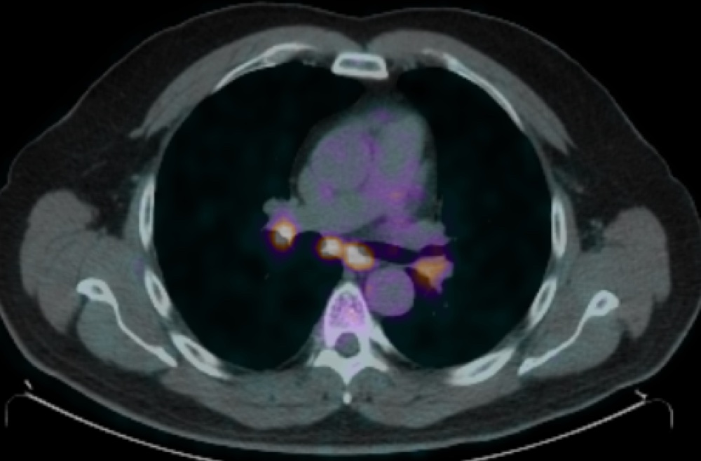 サルコイド様反応 FDG-PET/CT 融合画像 横断像