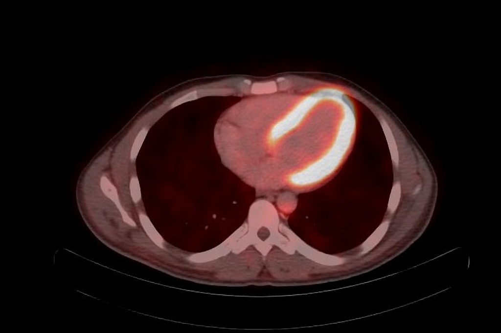 FDG-PET/CT 生理的な心筋集積 軸位断融合像