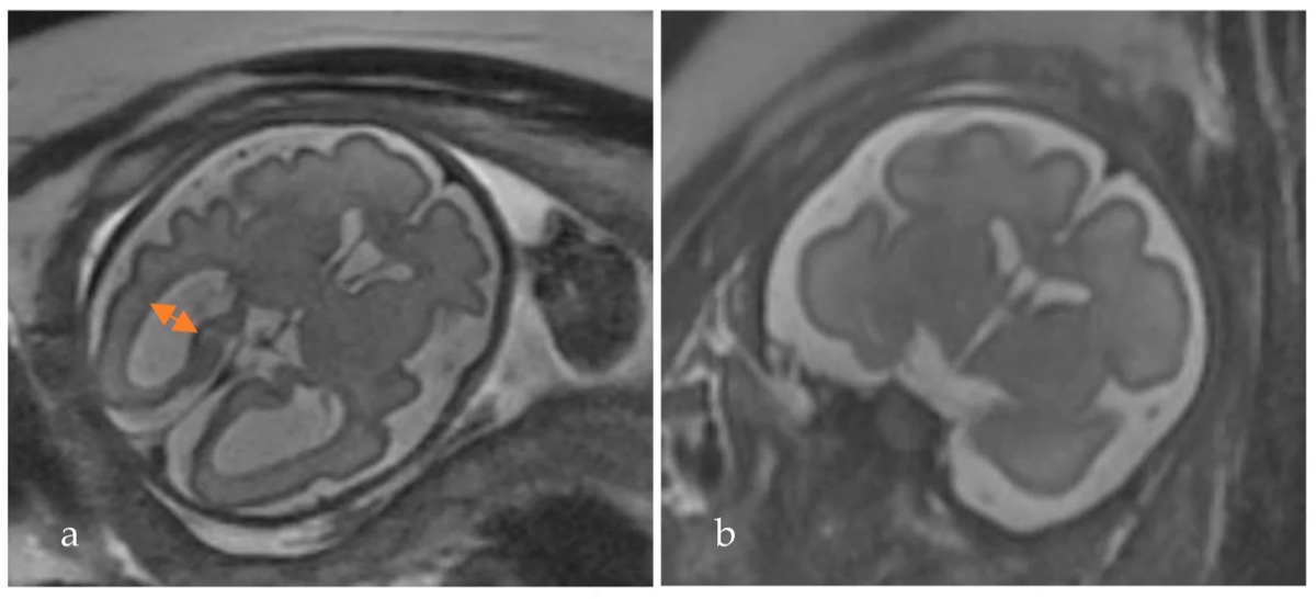 胎児MRI T2強調像 29週 軽度脳室拡大 11mm