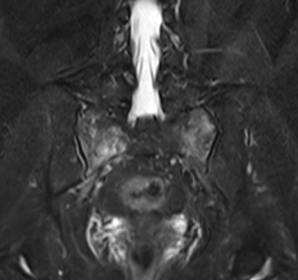 仙骨の脆弱性骨折 MRI STIR 冠状断像