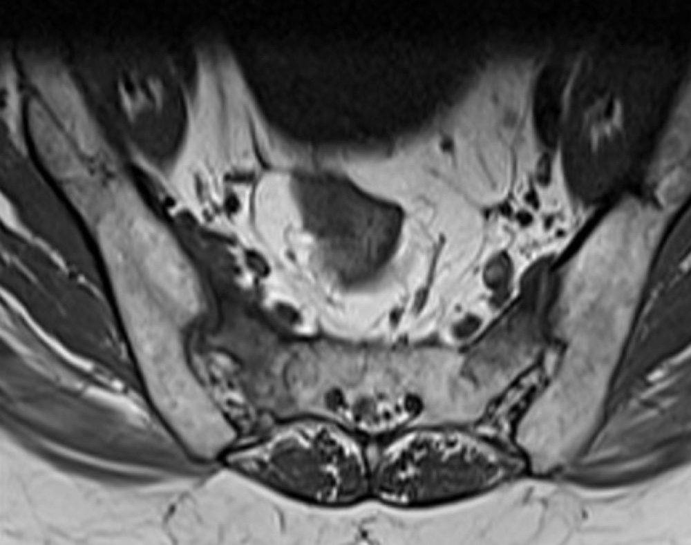 仙骨の脆弱性骨折 MRI T1強調像 横断像