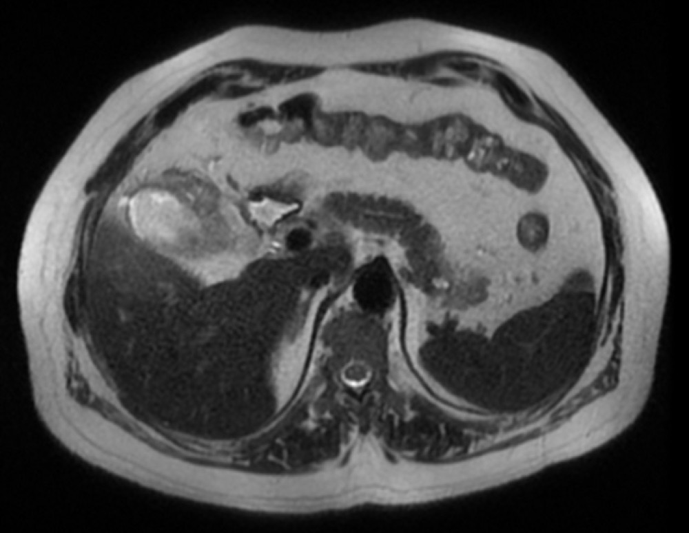 穿孔を伴う急性胆嚢炎 MRI T2強調像 横断像