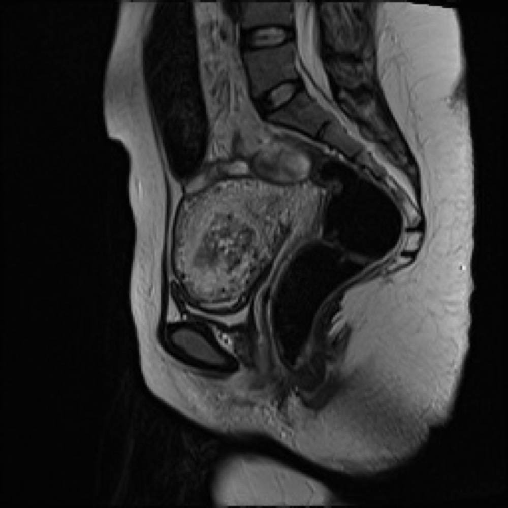 侵入奇胎 MRI T2強調像 矢状断像