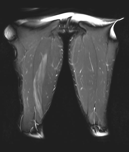 肉離れ(ハムストリングス) MRI 脂肪抑制T2強調像(TIRM) 冠状断像