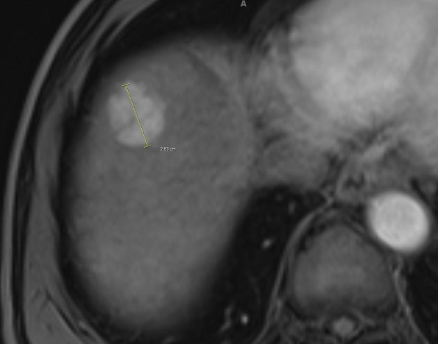 肝細胞癌(LI-RADS 5) 造影MRI 動脈相 横断像