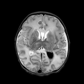 新生児低酸素性虚血性脳症 MRI T2強調像 横断像