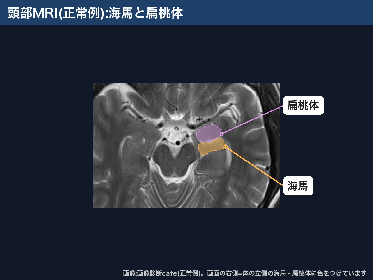 頭部MRI(正常例)の海馬と扁桃体の位置