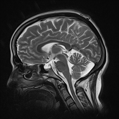 特発性頭蓋内圧亢進症 MRI T2強調像 矢状断像 empty sella
