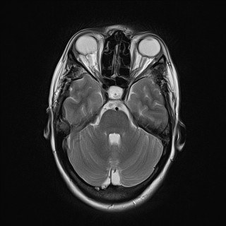 特発性頭蓋内圧亢進症 MRI T2強調像 横断像 視神経鞘拡大