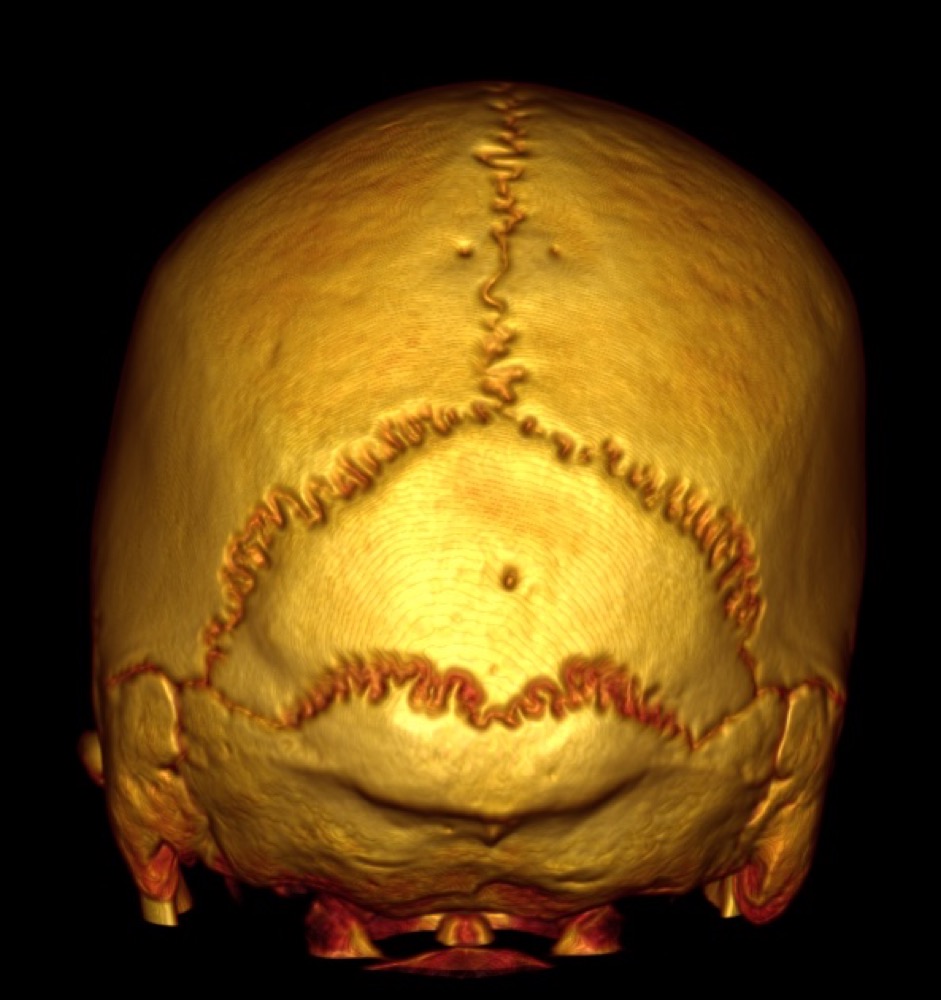 インカ骨 頭部CT 3D画像 後方から