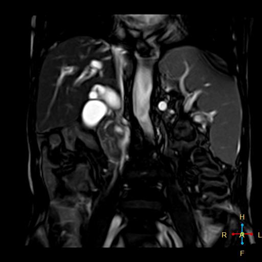 総胆管結石による胆道閉塞 MRI T2強調 冠状断像